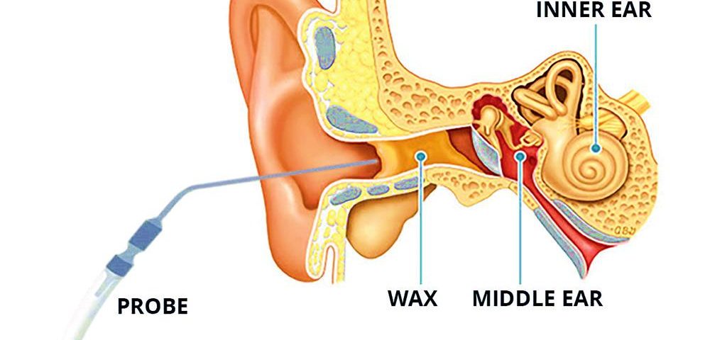 Ear wax. Earwax перевод. Очиститель ушной серы. Ухо серная серная пробка. Женщины чистят уши.