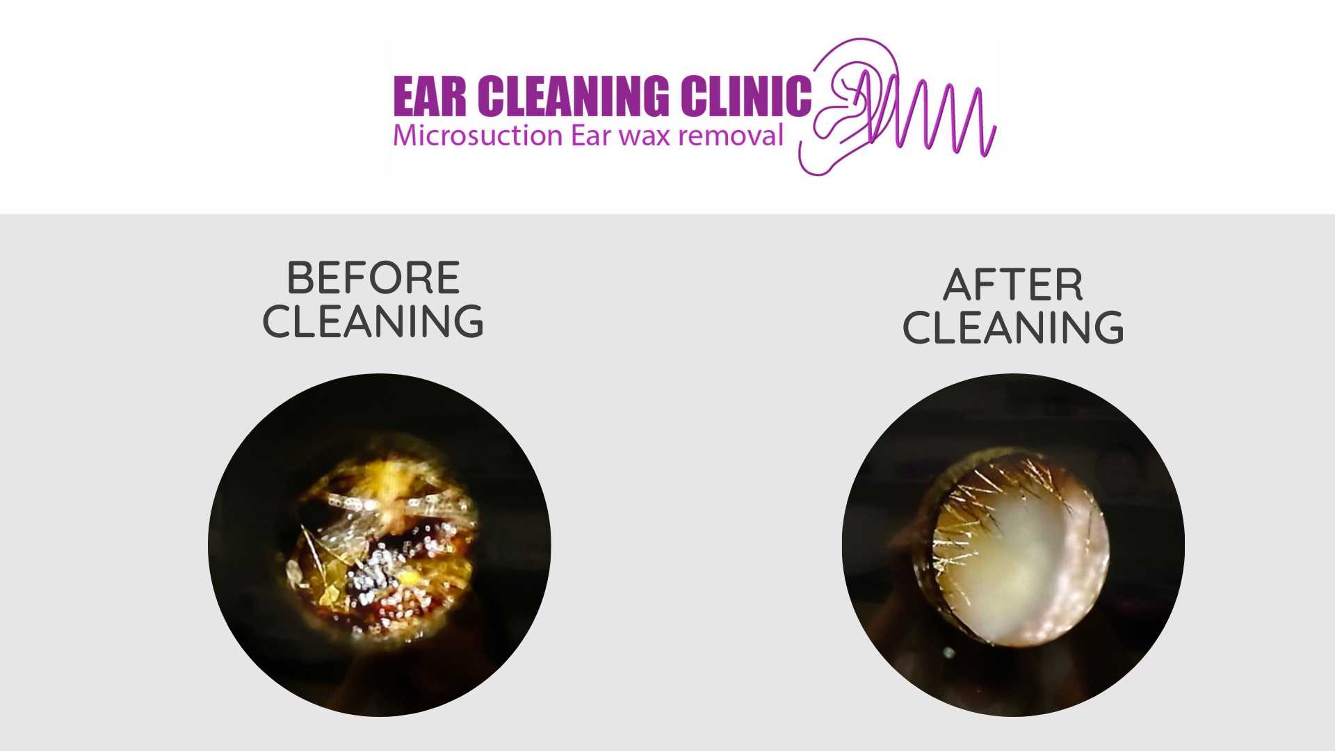 Blocked Hearing Wax Removal & Microsuction Gold Coast Ear Cleaning Clinic